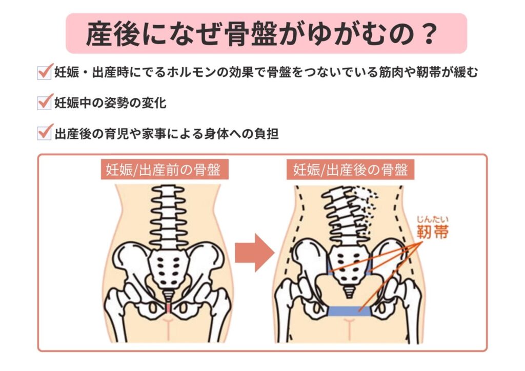 なぜ骨盤がゆがむ？