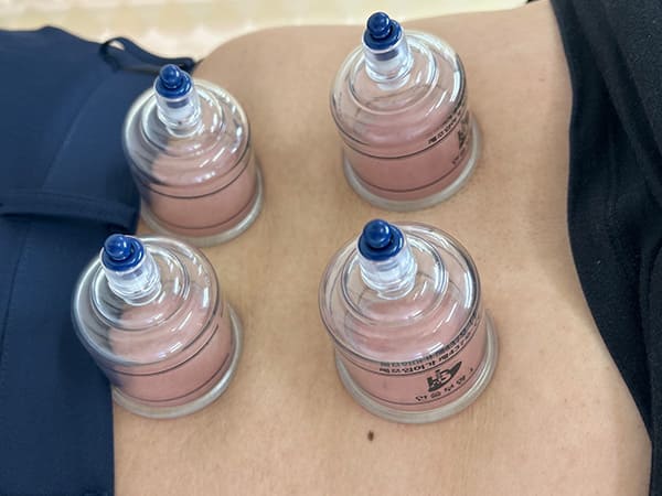 カッピング