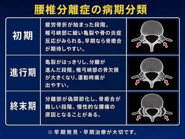 腰椎分離症の病期分類