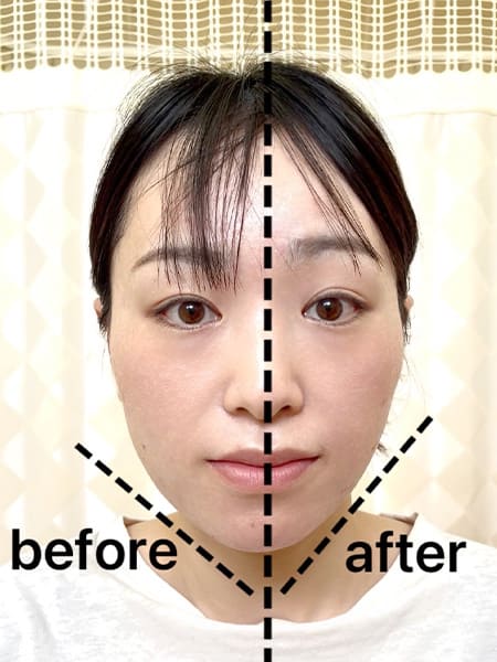 美容鍼before-after