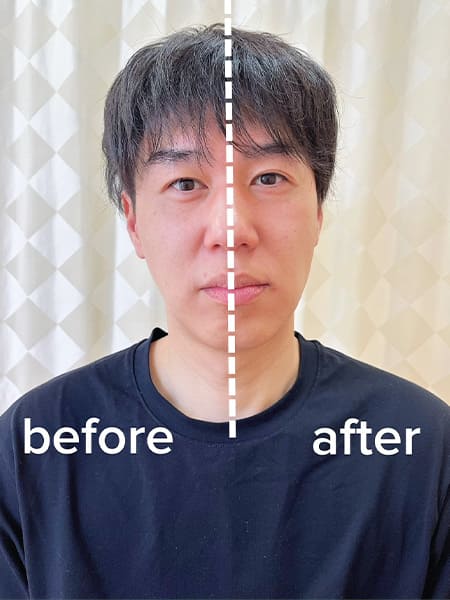 美容鍼before-after