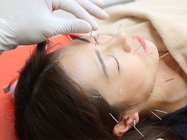 美容鍼施術
